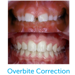 Before and after photo of overbite correction with the Healthy Start System.