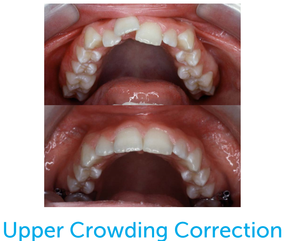 Before and after photo of upper crowding correction with the Healthy Start System.