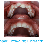 Before and after photo of upper crowding correction with the Healthy Start System.
