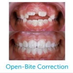 Before and after photo of open-bite correction with the Healthy Start System.