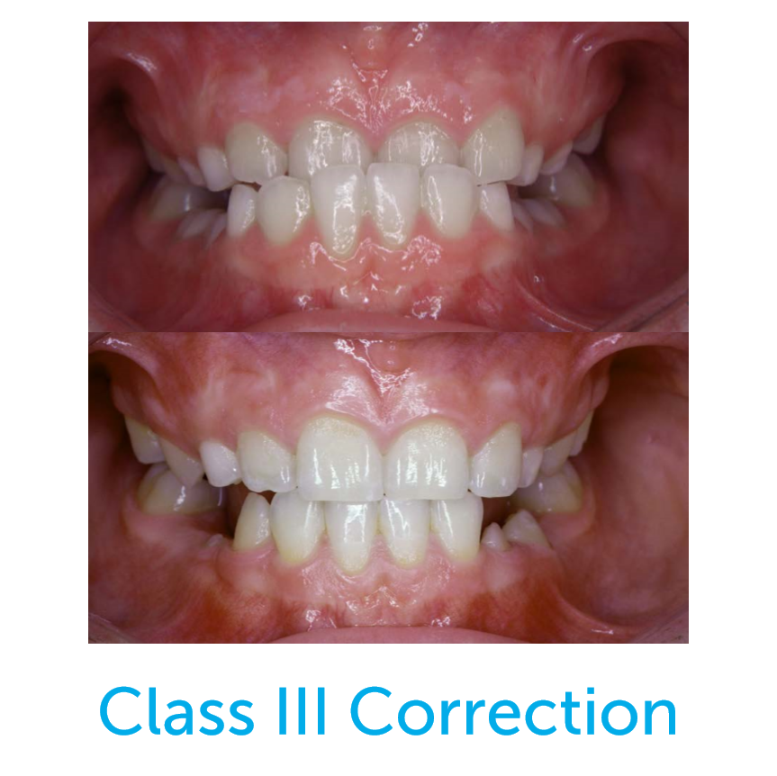 Before and after photo of a class III correction with the Healthy Start System.