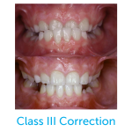 Before and after photo of a class III correction with the Healthy Start System.